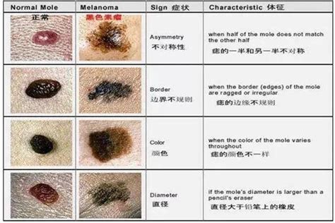 身上痣|哪些痣会癌变？脸上的痣能点吗？专家这回终于说清楚了